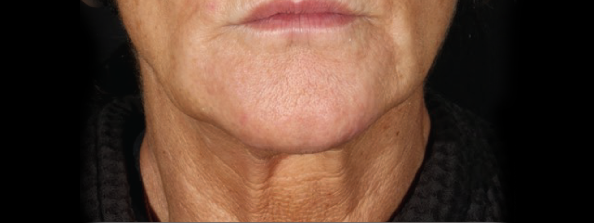 XERF after treatment result one