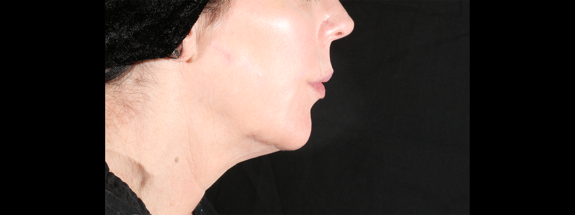 XERF after treatment result two