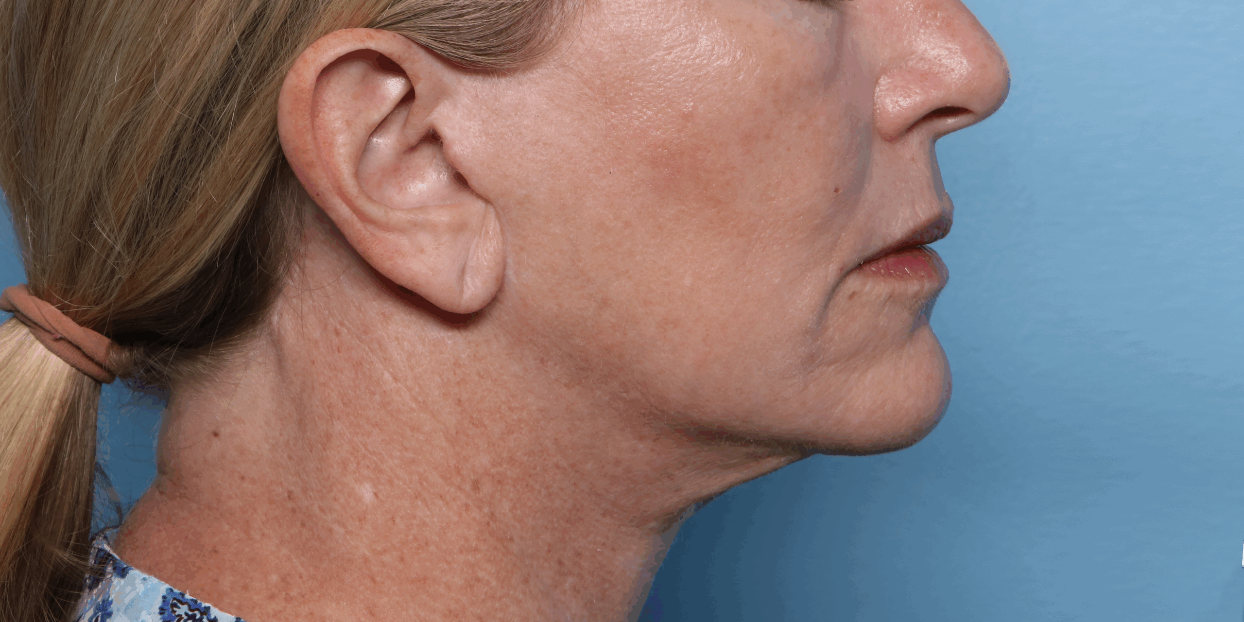XERF after treatment result three