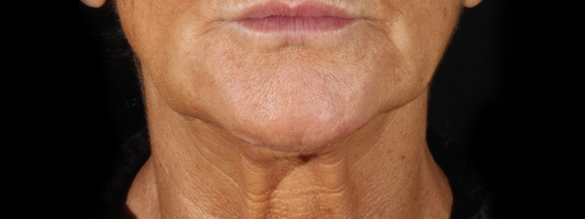 XERF before treatment result one