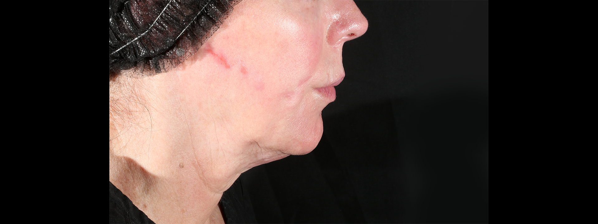 XERF before treatment result two