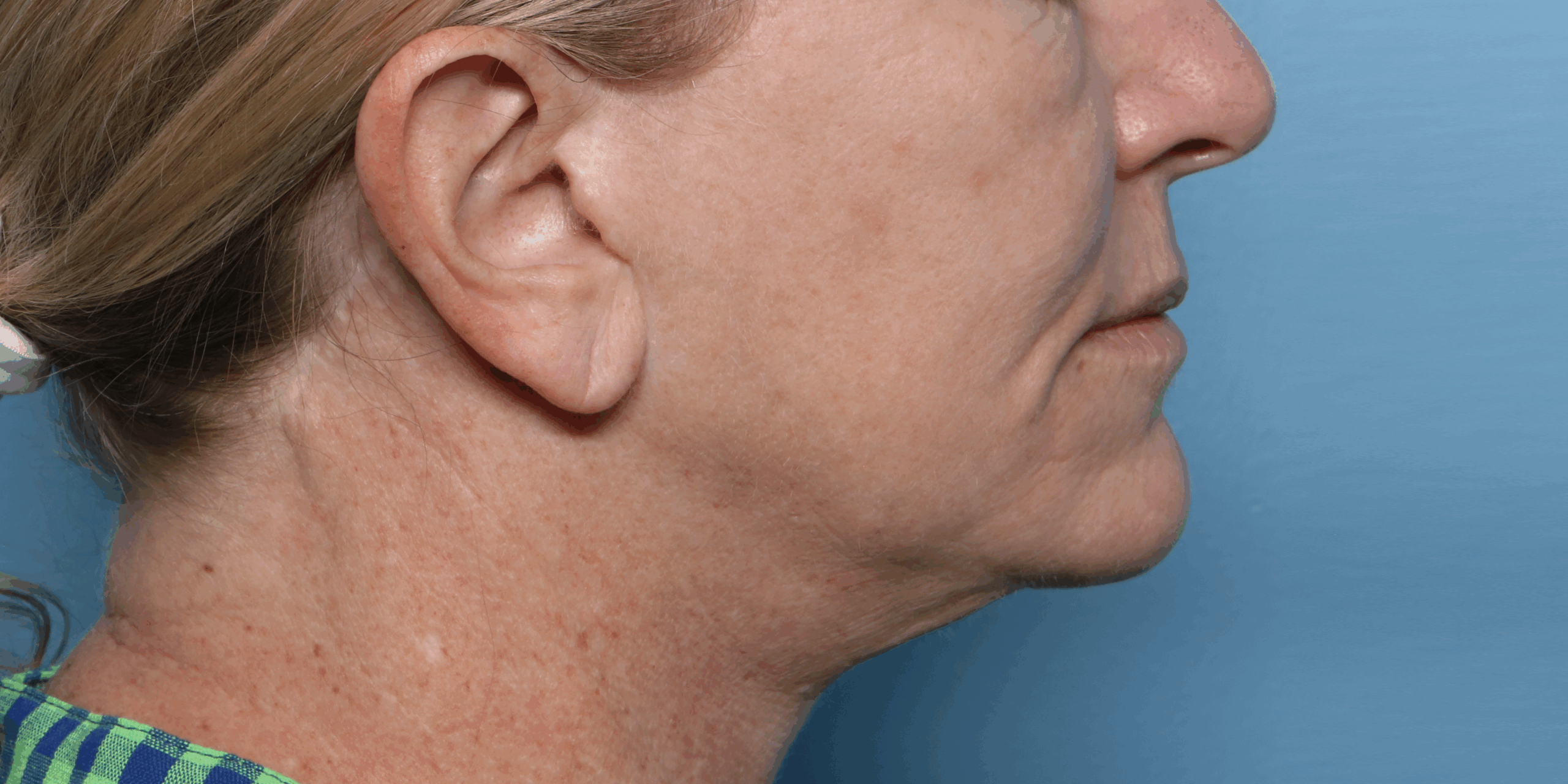 XERF before treatment result three